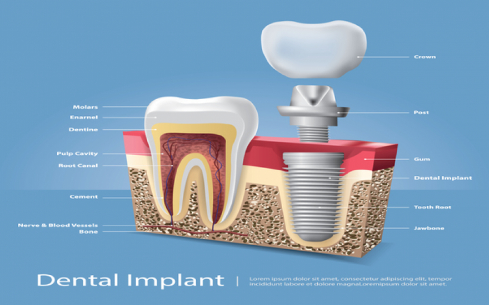 Understanding the Benefits of Dental Implants for Restoring Your Smile